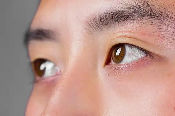 眼白发黄,是怎么回事?