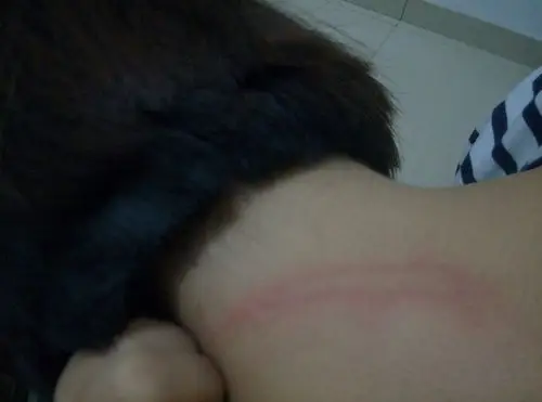 我的脖子起初有一小块黑色的东西,去看病搽了炉甘石洗涤济,就开始掉皮