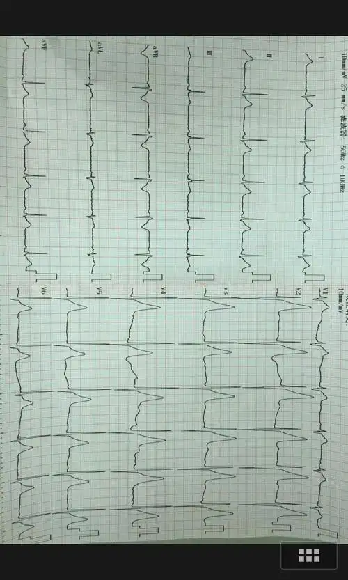 左胸刺痛2年,发现心电图t波高尖1年 两年前卧床,大量吸烟后出现左胸