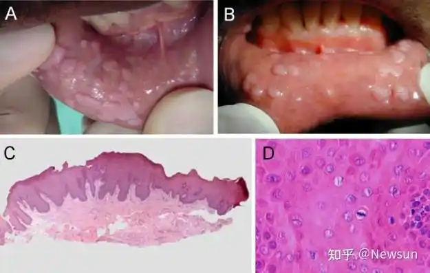 口腔hpv感染都有哪些症状?(附图片)