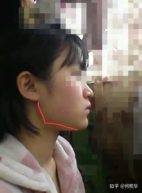 大概15岁起有按摩下颌骨的习惯,左右脸不对称,牙齿深覆合下颌骨突出