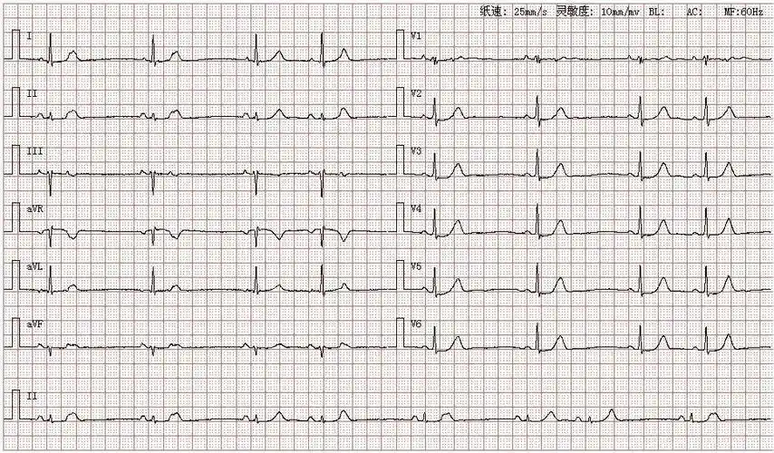 心电图图库丨房性早搏系列