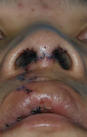 唇腭裂随访唇裂二期修复手术术后1年2月2013年7月手术