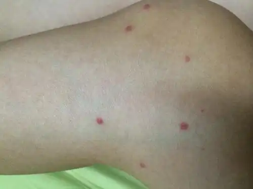 问:腿上胳膊上起了很多红点,后来越来越多,现在红点继发变成小水泡一