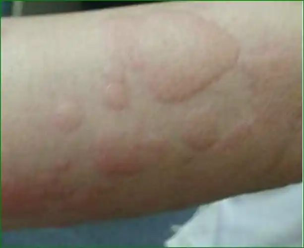 寒冷性荨麻疹手背皮肤病图片