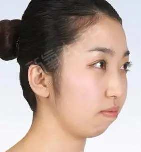 下巴短缩有什么后果?有的人嘴凸_圈子-新氧美容整形