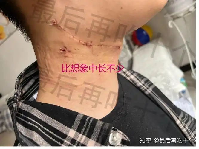 分享我的鳃裂囊肿治疗过程良性颈部肿物