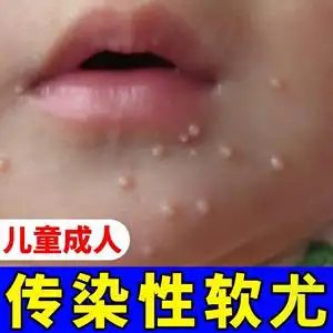 传染性软疣儿童病毒性去软疣膏刮勺镊子去除治工具疗水猴子药