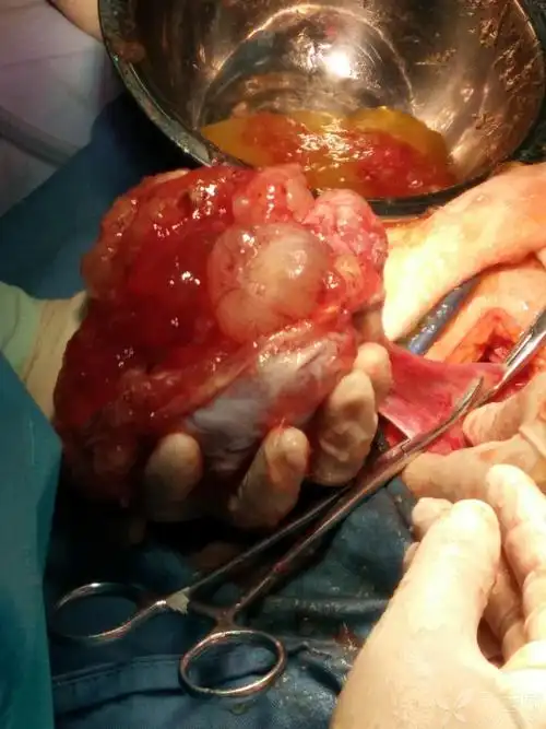 妇产版考考你的基本功# 这是什么类型的肿瘤?(答对有丁当奖励)