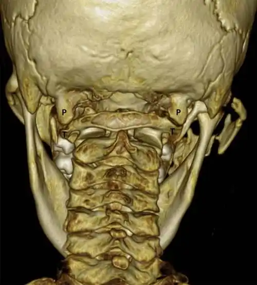 罕见先天性发育异常枕骨异常突起1例