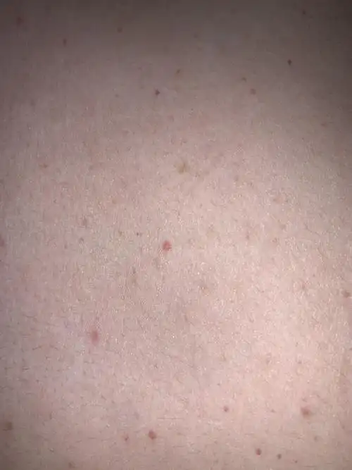 皮肤上出现红点