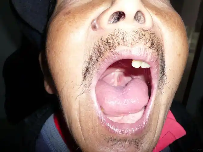 没有悬雍垂的人,有真图.