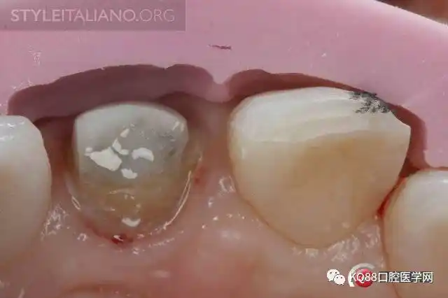 前牙金属桩核处理案例