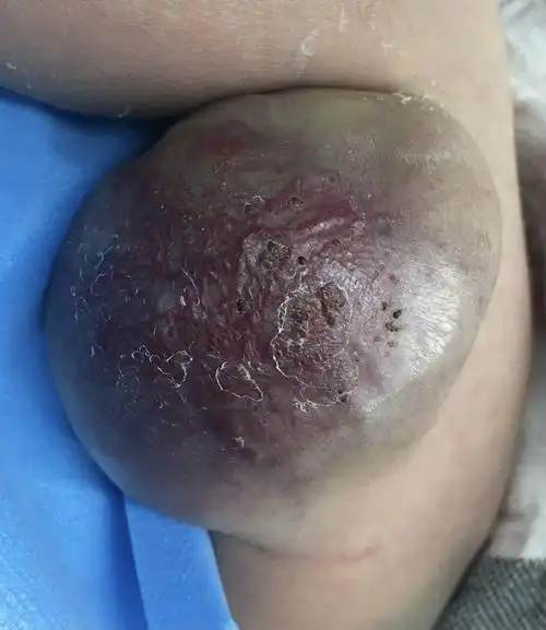 儿童血管畸形/静脉畸形医学科普_血管瘤_介绍_症状表现_治疗方式_日常