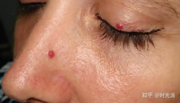 老年性血管瘤("樱桃样"血管瘤)