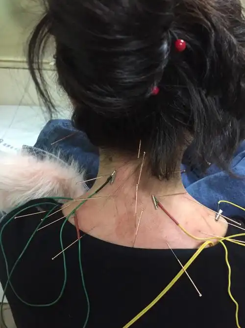 颈椎病在针灸治疗