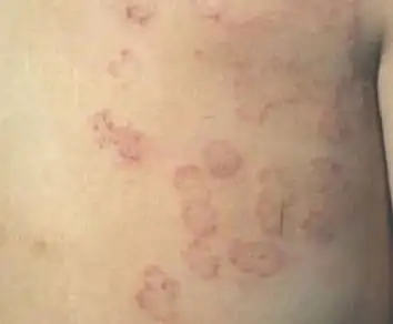 体癣的初期病情表现有哪些呢