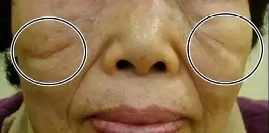 "印第安纹"又称颧颊沟,指的是颧骨下侧因颧骨韧带及_圈子-新氧美容