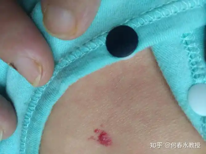 认识婴幼儿血管瘤