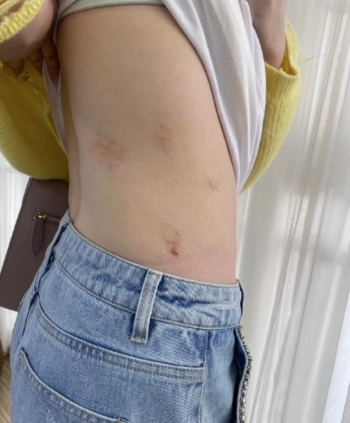 腰部疤痕遮盖纹身设计水彩美人鱼纹身女4