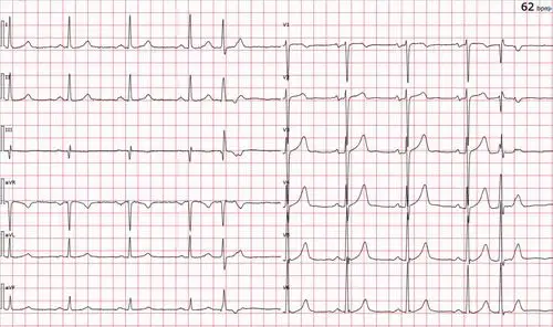 心电图图库丨交界性早搏系列