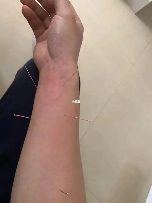 但是好多西医不会这套,老式西医还是开药为主.#痛症