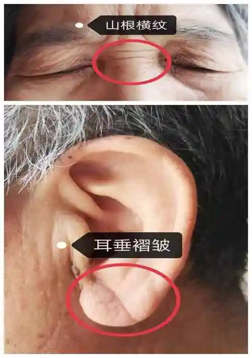 "鼻根有横纹,耳垂有褶皱"就表示有冠心病吗?