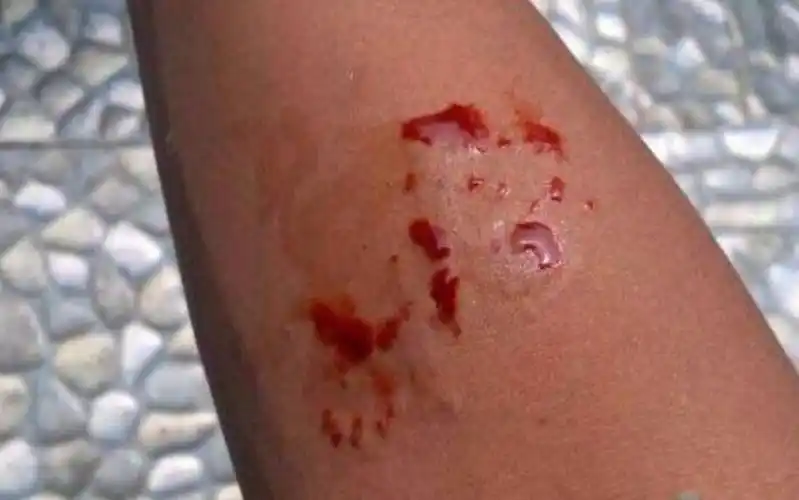 男子被毒蛇咬伤,却不去医院还发朋友圈炫耀,接下来悲剧了