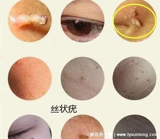 丝状疣和皮赘怎么区分图片