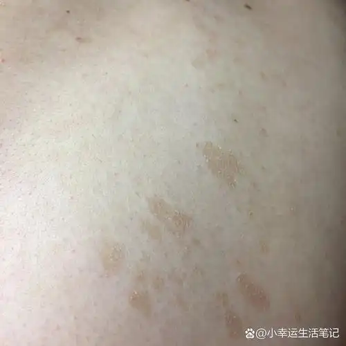 花斑癣(汗斑)&玫瑰糠疹