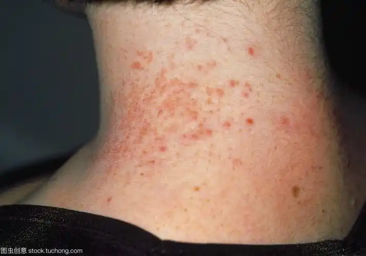 湿疹,皮炎,荨麻疹,皮肤科常见病的诊断及联合用药方案汇总大全