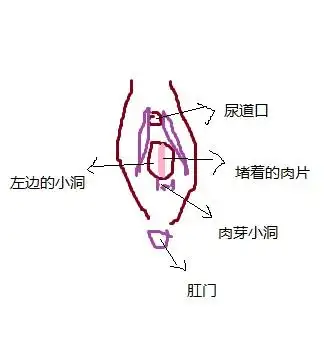 医生,我的尿道口下方我看到有一个很大的圆形封闭的洞,暂且说它是洞吧