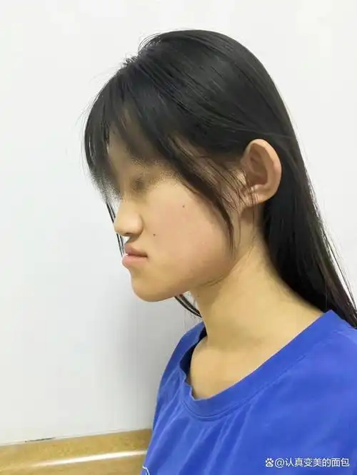 女孩地包天多大年龄矫正最好?