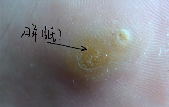 图解跖疣,鸡眼和胼胝三者区别