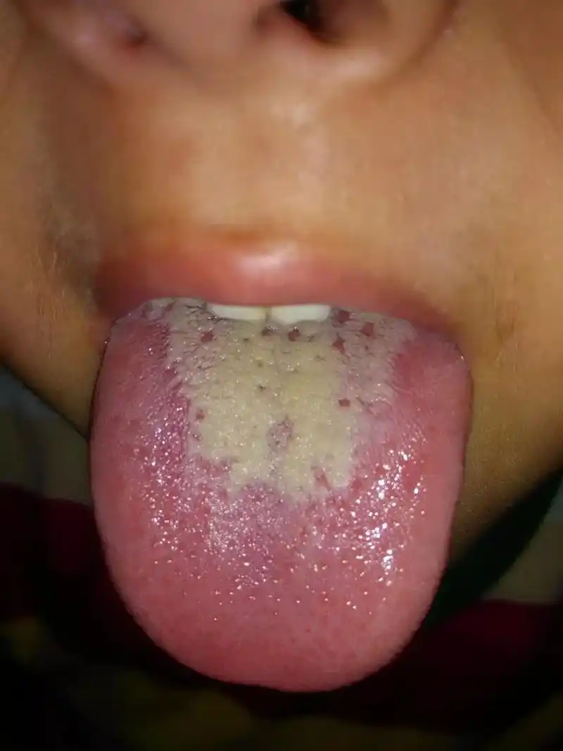 一个积食的舌苔处理前后变化