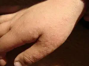 小儿丘疹性肢端皮炎