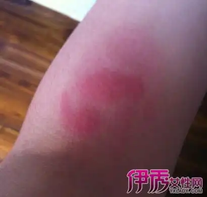 如何辨认蟑螂咬人的伤口-知言识新