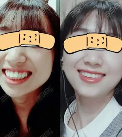 龅牙的烦恼:牙齿整齐但是嘴巴前凸怎么矫正?