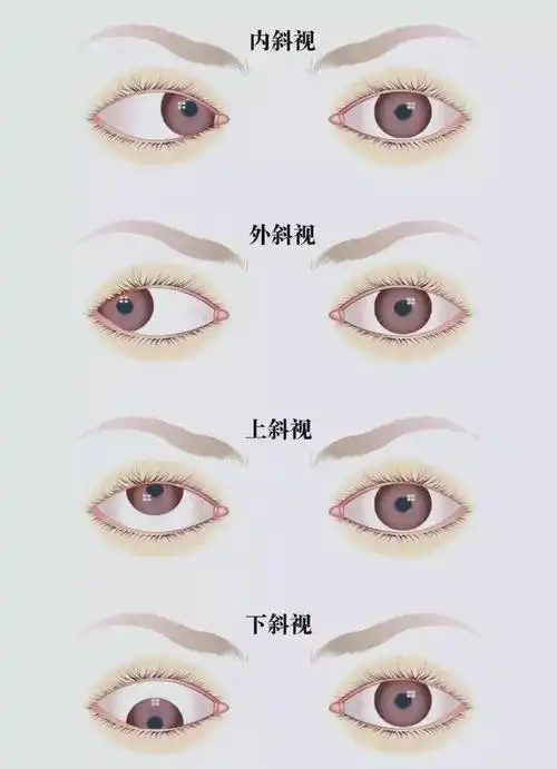 当孩子被人称呼"斗鸡眼"的那一刻,我心痛难忍|斜视|眼科|眼病|内斜视