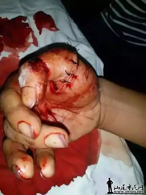 梅陇西环路新桥出现抢劫,男子被砍,伤势严重!