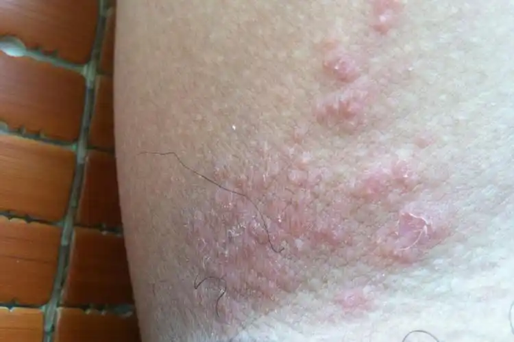 接触刺激性物品的皮肤表面,出现红色丘疹,有时还会形成水疱,伴随瘙痒