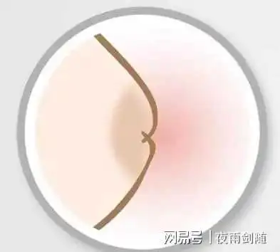 除了大小,同样令人烦恼的乳头内陷|炎症|乳腺炎|导管_网易订阅