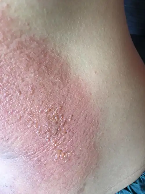 艾灸后皮肤出水泡