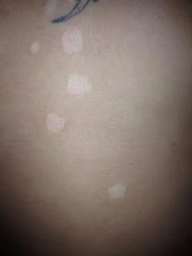 胸前长一些白点,不知道是什么,是汗斑还是白癜风啊?