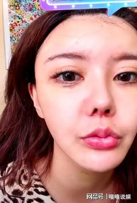 整容整到变形的8位网红脸崩颅内灌水睡觉合不上眼太惨了