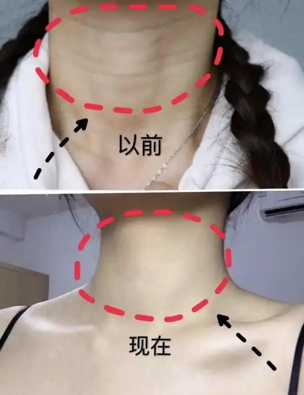 女人的脖子出现"3道杠",你知道是什么信号吗?女人要趁早了解