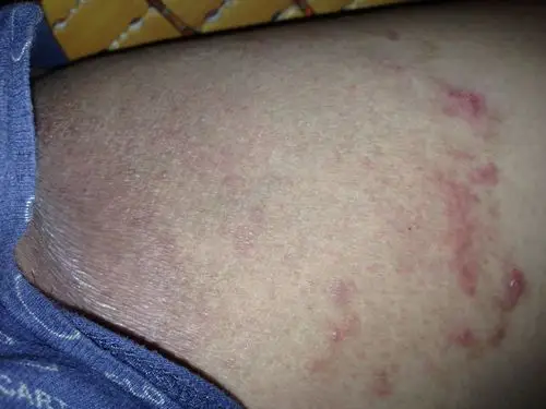 好可怕皮肤病,越来越大了!