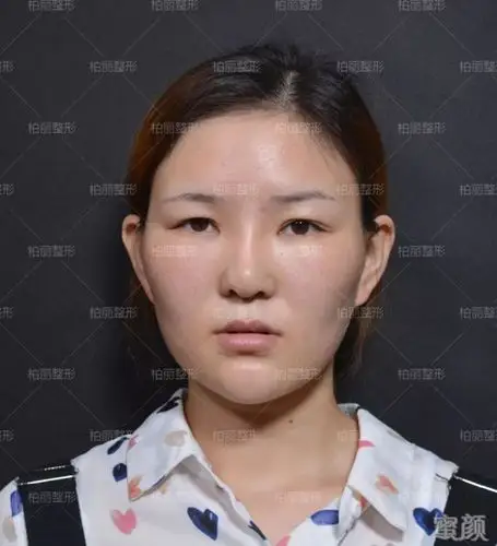 鼻子决定颜值,鼻尖影响鼻子的美!【李劲良真人案例】