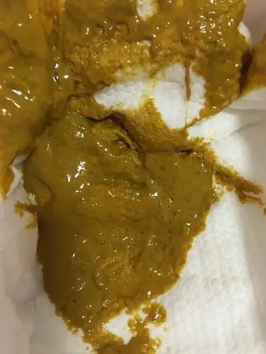 恶心慎入!急急急,这样的大便是怎么了