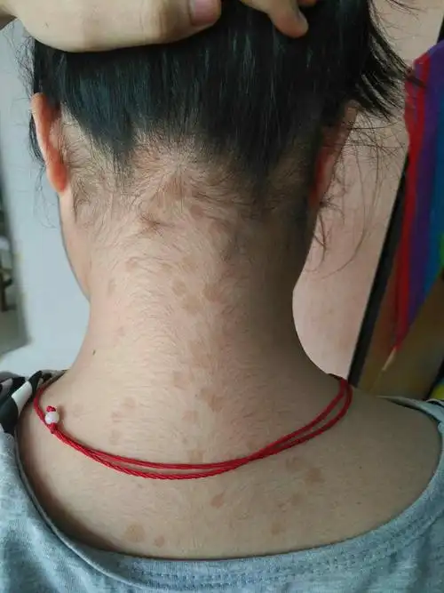 汗斑不治疗行不行急急急